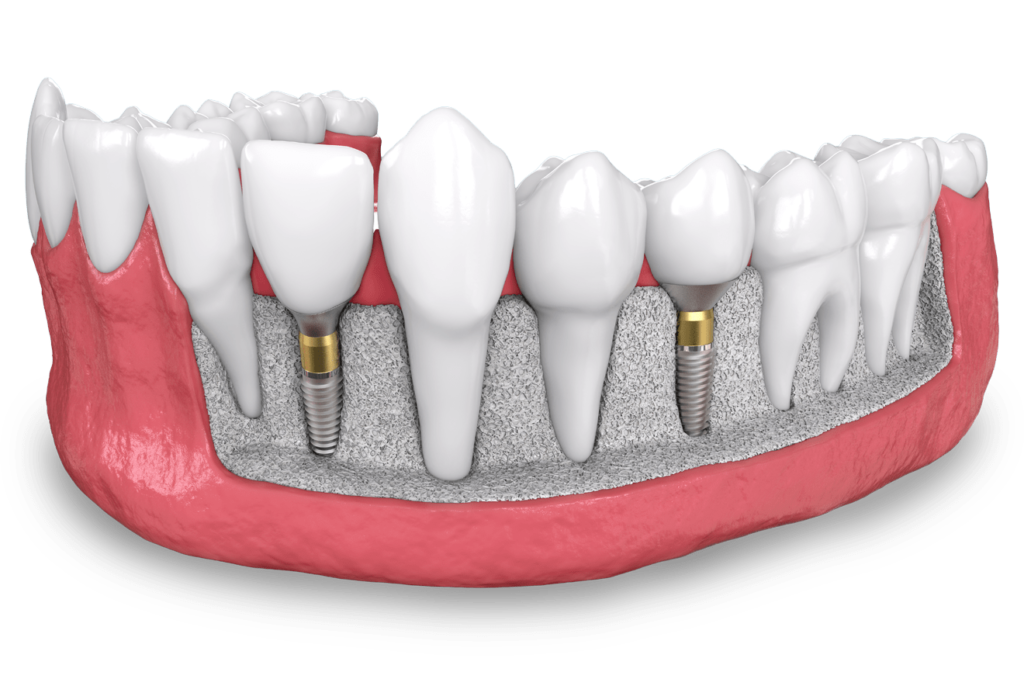 dental implant model St. Johns, MI