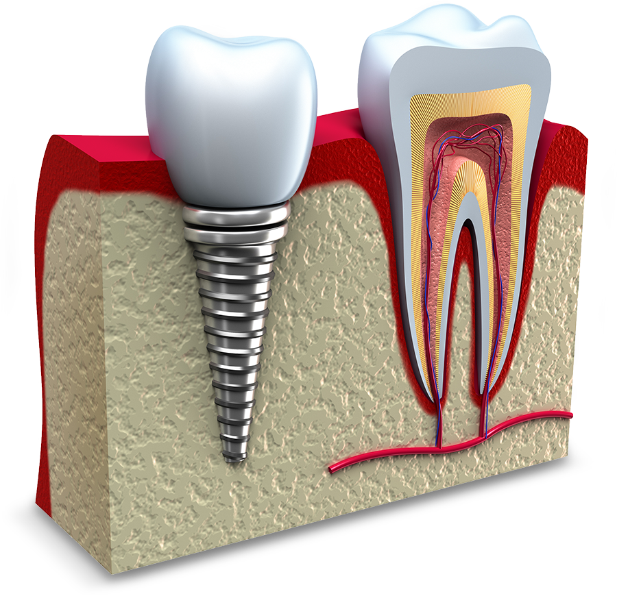 failing dental implant model St. Johns, MI