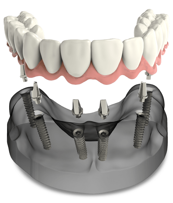 full arch dental implants model St. Johns, MI