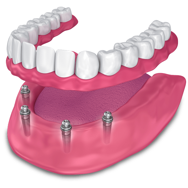 implant supported dentures model St. Johns, MI